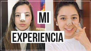 Mi Experiencia Cirugía de Nariz Mariewithem [upl. by Coyle284]