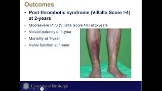 Post Thrombotic Syndrome Morbidity In Mechanical Thrombectomy Vs CDT of Iliofemoral DVT [upl. by Oralle]