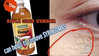 how to remove SYRINGOMAS using apple cider venigar [upl. by Odlareg]