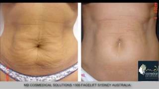 Stretch marks treatment with fraxel restore laser Sydney [upl. by Aramoiz]