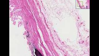 Histopathology Aorta Atherosclerosis [upl. by Yras91]