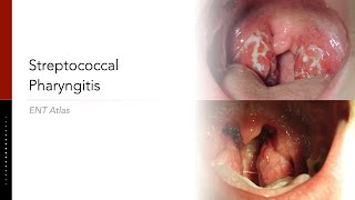 Streptococcal Pharyngitis [upl. by Ahsirahc572]