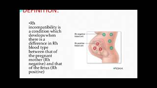 Rh incompatibility in pregnancy  Rhesus Status and AntiD in Pregnancy [upl. by Vaclav582]