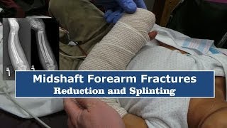 Reduction amp Splinting of Forearm FracturesQuick Version [upl. by Ellebana]