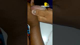 IV Cannulation Procedure technique mbbs shortvideo [upl. by Hollyanne89]