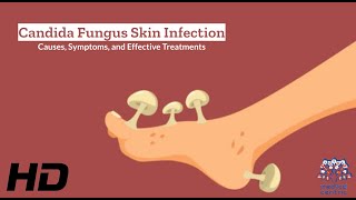 Candida Fungus Skin Infection Explained What You Need to Know [upl. by Eliades]