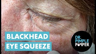 Blackhead Eye Squeeze [upl. by Georgena]