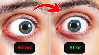 👁️ Powerful Exercises for Lazy Eye 💪 [upl. by Arul]