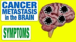 Cancer Metastasis in the Brain  All Symptoms [upl. by Mathre]