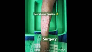 necrotising fasciitis vericosevein complicates surgery✨🩺🏥🏥🩺💊⛑️⛑️Sudarshanlipane17 [upl. by Meggs]