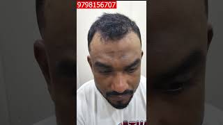 Hair Transplant Result 7 MonthCost of Hair TransplantHair Transplant in jharkhand [upl. by Moriarty70]