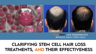 What You Need to Know About Stem Cell Hair Restoration and the Treatments that Work [upl. by Fine]