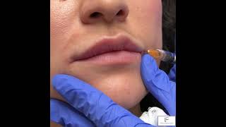 Lip Filler Cannula [upl. by Doralynn434]