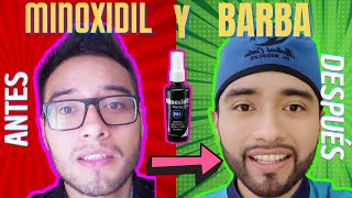 LO QUE NADIE TE HA CONTADO DEL MINOXIDIL EN LA BARBA 🧔 OPINIÓN MÉDICA [upl. by Pope]