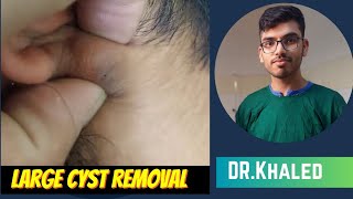 Large cyst removal by dr khaled hasan milu [upl. by Aisan]