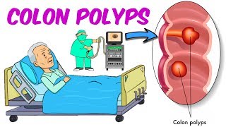 Colonic Polyps [upl. by Asi835]