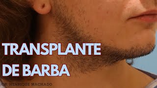 Transplante  Implante de Barba [upl. by Magulac]