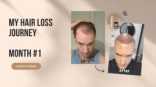 Hair Transplant Full Month HLC Clinic Turkey Review [upl. by Gaye]