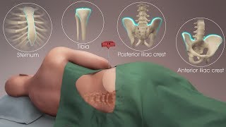 Bone Marrow Aspiration and Biopsy Live [upl. by Dorry]