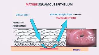 Colposcopy – Technique and Interpretation by Dr Usha Saraiya [upl. by Dyanne301]