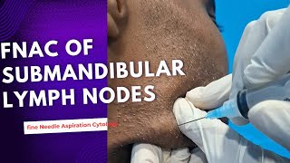 FNAC of Submandibular lymph nodes ।। [upl. by Nhar]