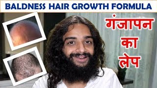 गंजापन का लेप BALDNESS AYURVEDIC HOME REMEDY HAIR REGROWTH FORMULA BY NITYANANDAM SHREE [upl. by Ysabel]