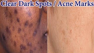 Home Remedy To Get Rid Of Dark Spots Acne Marks Naturally Fast [upl. by Enrobialc]