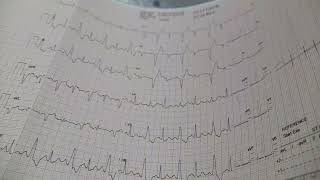 Rate dependant LBBB in Stress ECG Test [upl. by Irrok72]