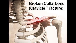 Broken Collarbone Clavicle Fracture [upl. by Aikyt]