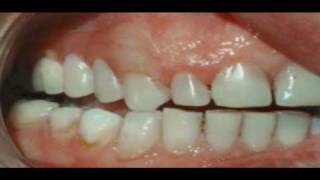 Why Have a Valplast Flexible Denture [upl. by Borrell]