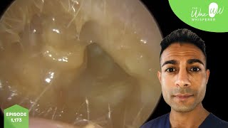 1173  Bursting Eardrum after Discharge amp Ear Wax Removal [upl. by Buffo515]