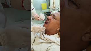 complex root canal of mandibular premolar [upl. by Yror]