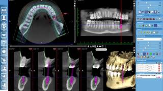 Basic Implant Planning in Romexis 1 [upl. by Beaver655]