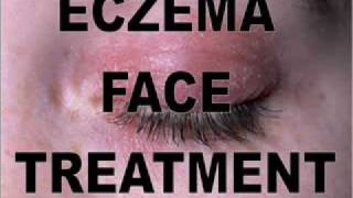 How To Treat Exzema Face  Exzema Face Remedies [upl. by Hessler868]