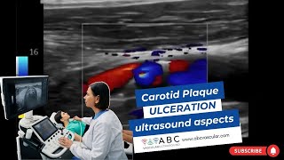 CAROTID PLAQUE ULCERATION ULTRASOUND ASPECTS [upl. by Stieglitz]