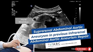 Abdominal Aortic Aneurysm AAA Ultrasound [upl. by Carey]