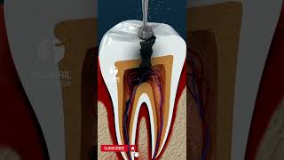 Root Canal Treatment [upl. by Aicertal]