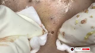 Big Cystic Acne Blackheads Extraction Blackheads amp Milia Whiteheads Removal Pimple Popping [upl. by Berman971]