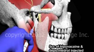 Bupivacaine Anesthesia of the Temperomandibular Joint TMJ  Animation by Cal Shipley MD [upl. by Pomfrey774]