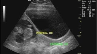 Ultrasound Of cervix External and internal OS [upl. by Adnerak]