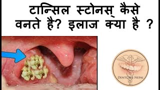 Tonsil Stones  Tonsilloliths Causes and Treatment  IN HINDI [upl. by Campbell]