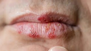 Globally g Of People Have Herpes [upl. by Lidah]