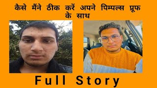 My Pimples Story  Best Medicine for pimples Homeopathic Medicines Sulphur [upl. by Menon684]