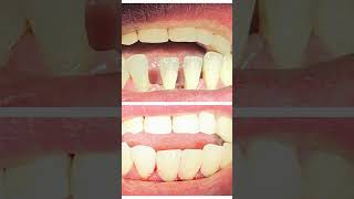 Diastema Closure  Dokter Gigi  Cuspaeni dentalcare veneers dentist trending fyp foryou jj [upl. by Tupler]