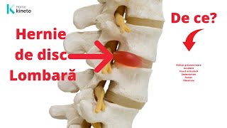 De ce se produce Hernia de disc lombară [upl. by Htial561]