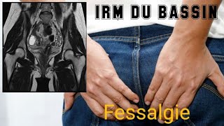 IRM DU BASSIN fessalgie inflammatoire sacroiliaque gauche irrégulière sur radio du bassin [upl. by Phaedra]