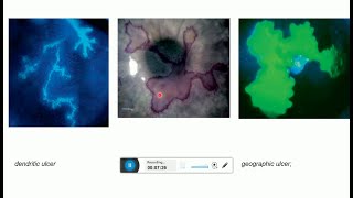 herpes simplex keratitis and herpes zoster ophthalmicus [upl. by Euginomod134]