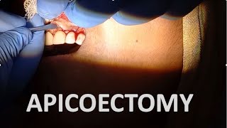 APICOECTOMY SURGERY STEPS IN APICOECTOMY INDICATIONS AND CONTRAINDICATIONS dentalcafe4331 [upl. by Elocal622]