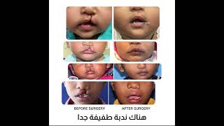 Cleft Lip Repair  Dr Dr Gagan Sabharwal  FUH in a Minute [upl. by Aham]