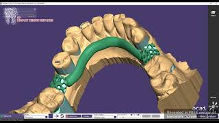 Upper Partial Denture designing [upl. by Sculley883]